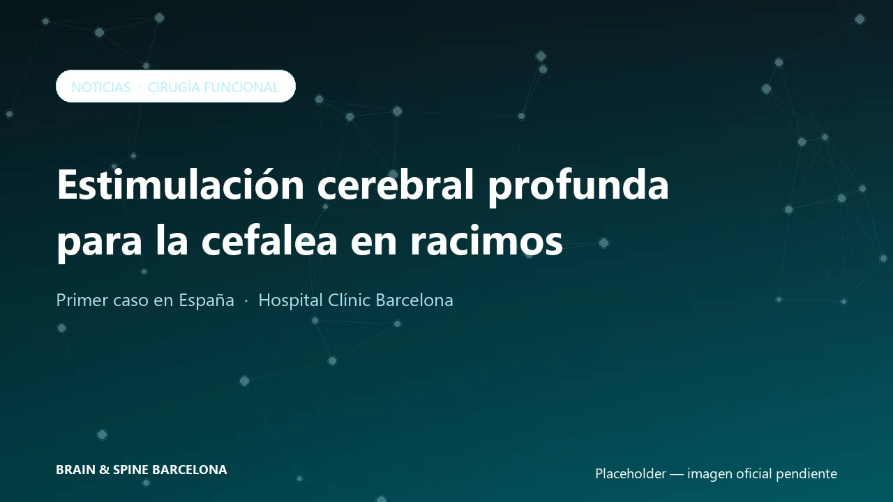 El Clínic prueba con éxito la estimulación cerebral profunda para controlar la cefalea en racimos